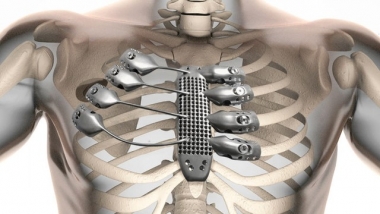 Ghép xương ức và xương lồng ngực in 3D bằng titan cho bệnh nhân ung thư