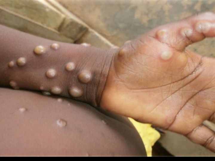 hình ảnh triệu chứng bàn tay bị mắc bệnh đậu mùa khỉ